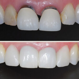 Crowns - Before & After - Cossmetic Dental Associates