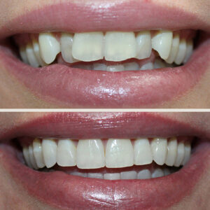 Invisalign - Before & After - Cossmetic Dental Associates
